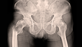 Fractured Hips